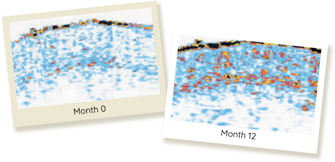 Ultrasound pictures showing Month 0 and Month 12