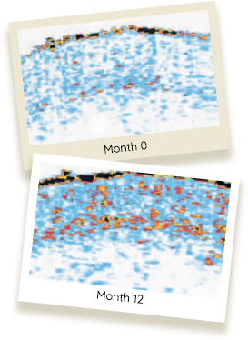 Ultrasound pictures showing Month 0 and Month 12